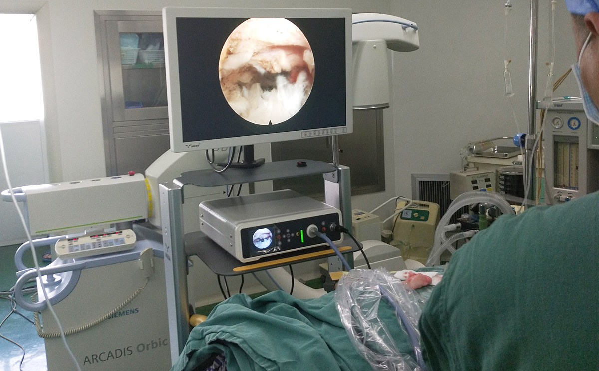 椎间孔镜手术应用案例