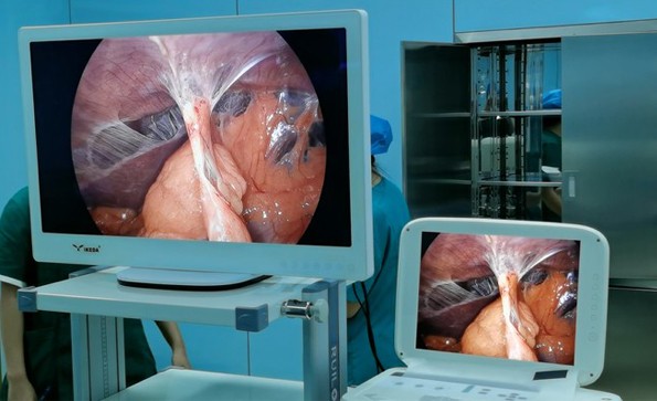 医用内窥镜摄像机（腹腔镜）临床应用